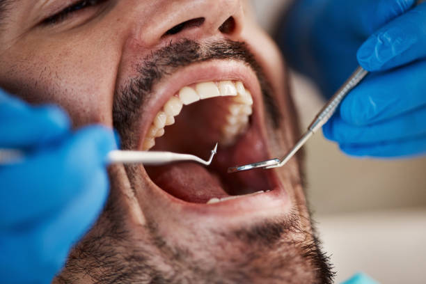 Best Emergency Dentist for Lost Fillings or Crowns in Aviston, IL